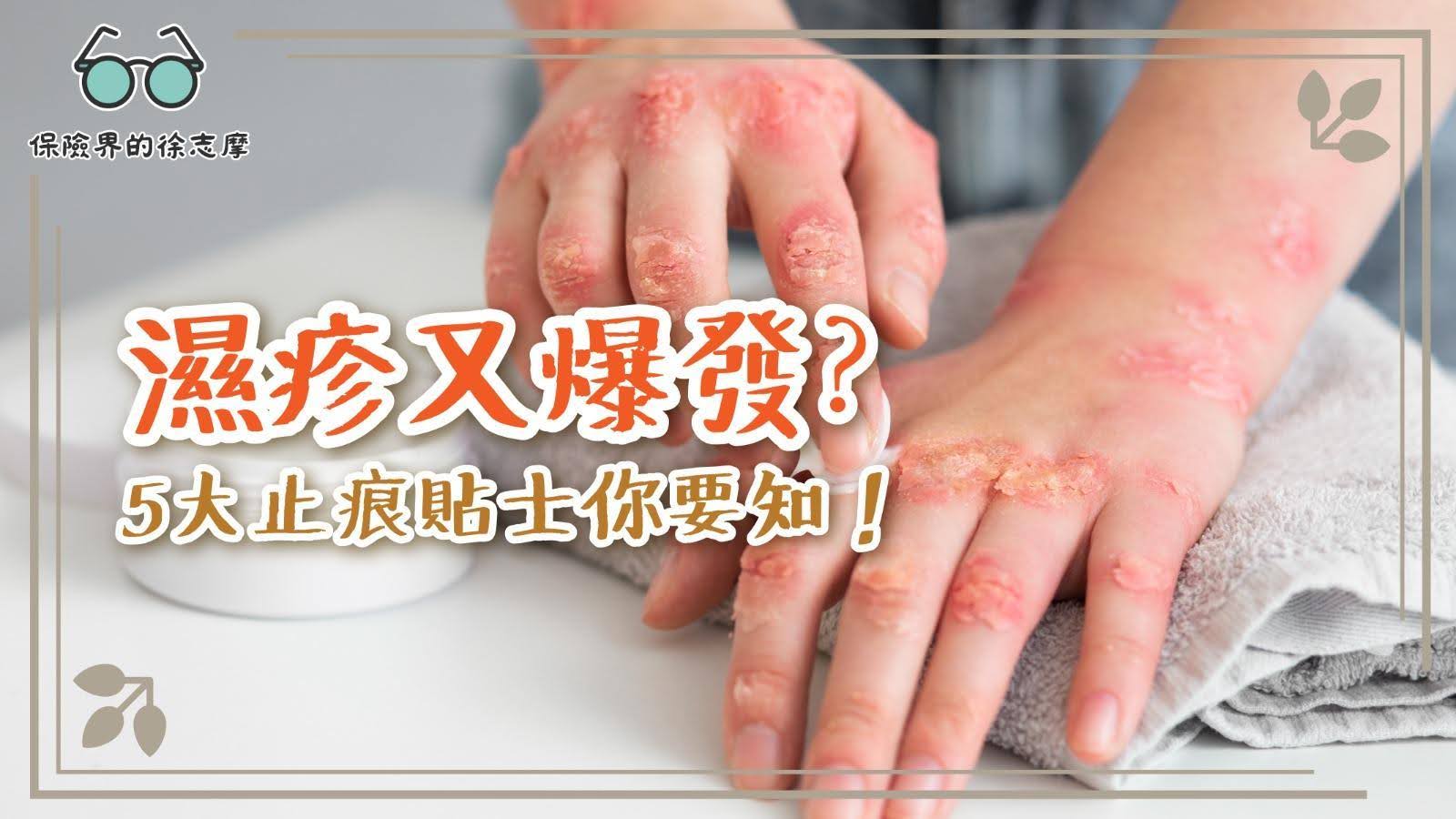 濕疹又爆發?5大止痕貼士你要知!